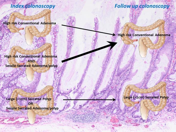 Serrated Polyps Plus Conventional Adenomas May Mean Higher Risk for Colorectal Cancer