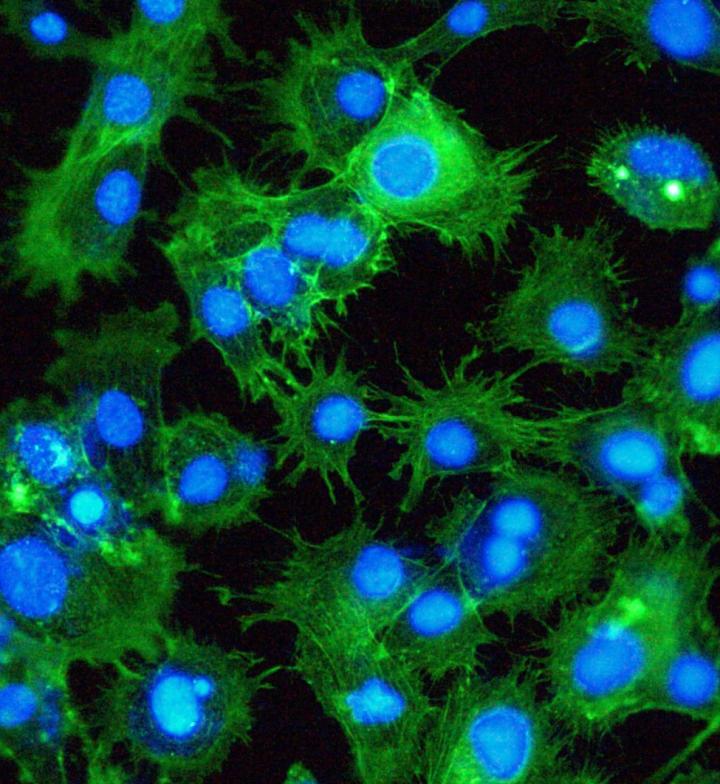 Breast Carcinoma
