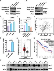 ADAR1 promotes liver cancer progression via post-transcriptional regulation of PPARγ