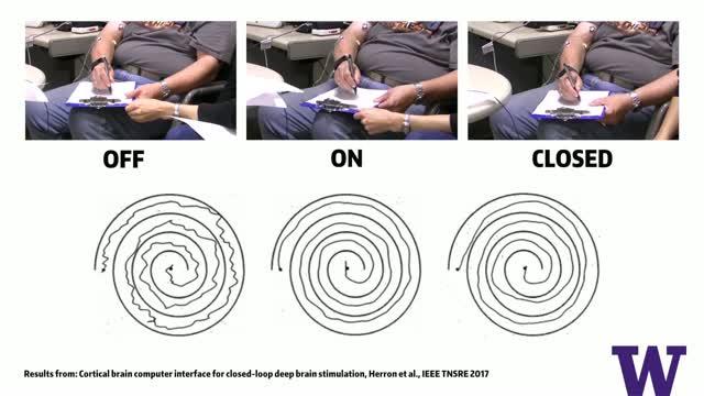 UW Closed-loop DBS Tremor Video