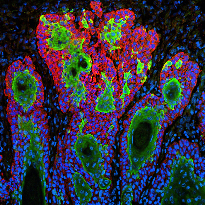 Skin cancer cells