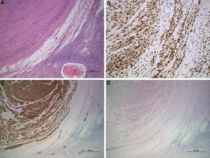 Histopathological features of ovarian leiomyomas.