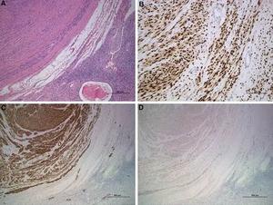 Histopathological features of ovarian leiomyomas.