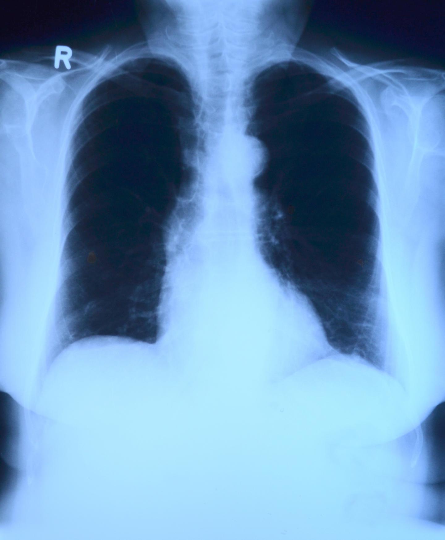 Conventional Chest X-ray