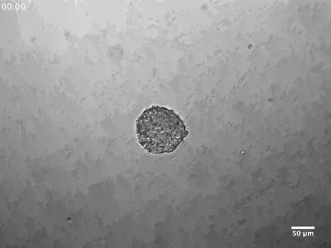 A Tumor Grown in the Laboratory from Breast Cancer Cells Grows Rapidly and Invades Its Surroundings
