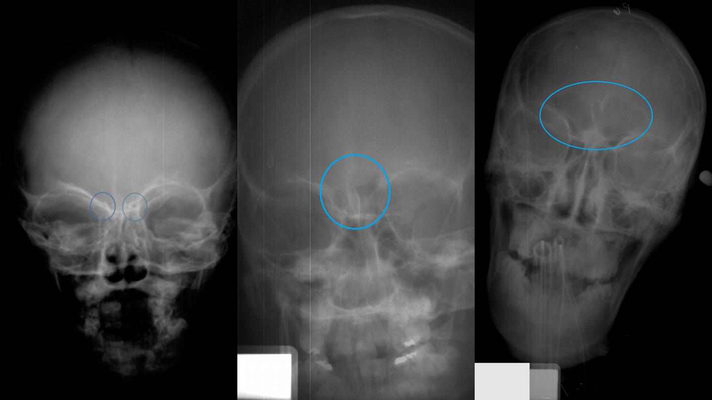 Frontal Sinus Varies With Age