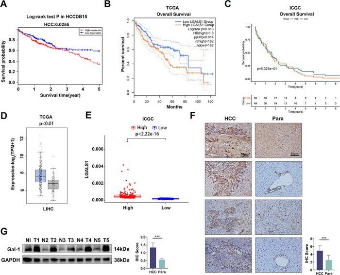 High Gal-1 expression is associated with hepatocellular carcinoma (HCC) progression