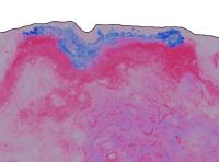 Zinc Oxide (ZnO) Nanoparticle Distribution in Excised Human Skin