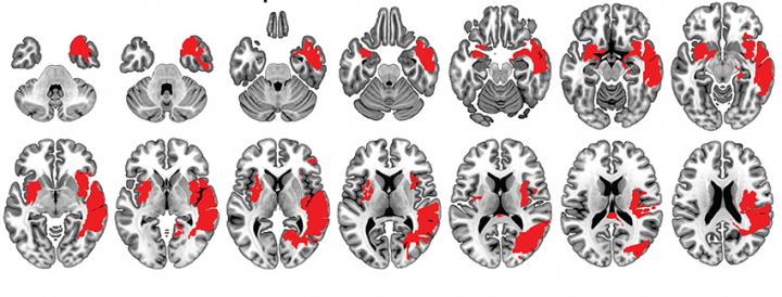 Lesion Extent