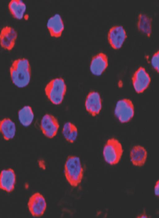 b-cell lymphoma lixin rui.jpg