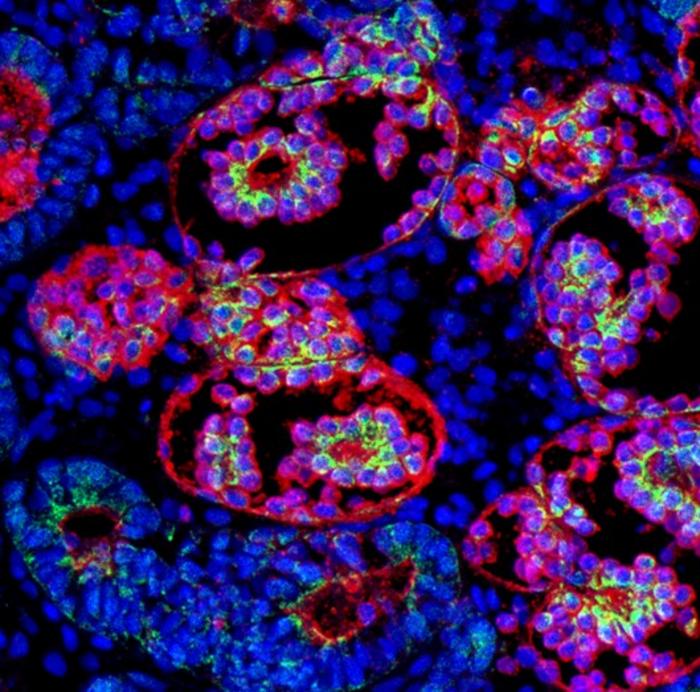Kidney Organoid Unlocks Genetic Cause of Chronic Kidney Disease