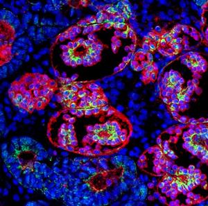 Kidney Organoid Unlocks Genetic Cause of Chronic Kidney Disease