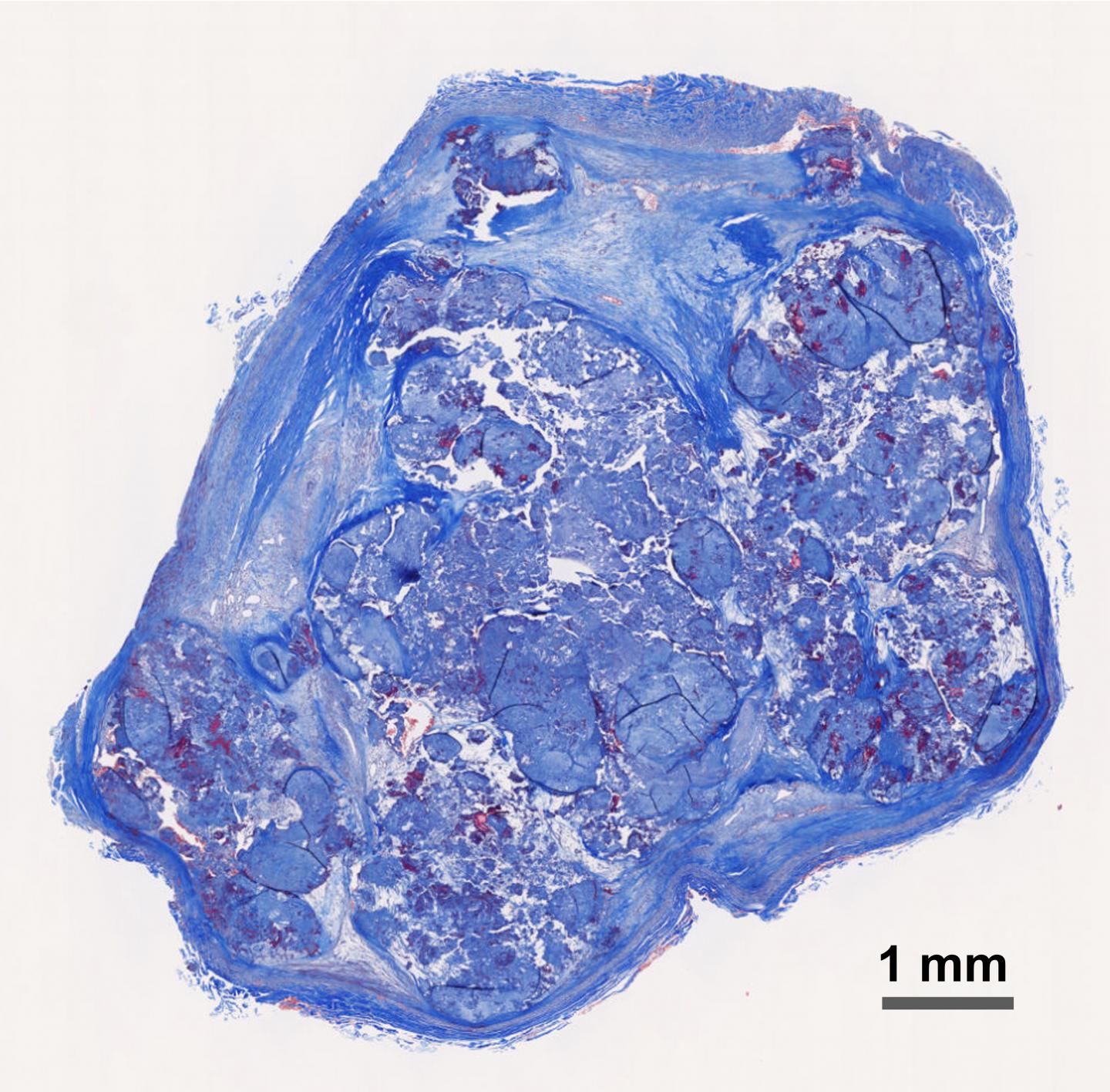 Patient-Derived Stem Cells Reveal Treatment Strategies for Rare Arterial Disease (2 of 2)