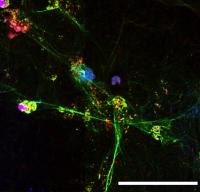 Neutrophils from a COVID-19 Patient Release NETs