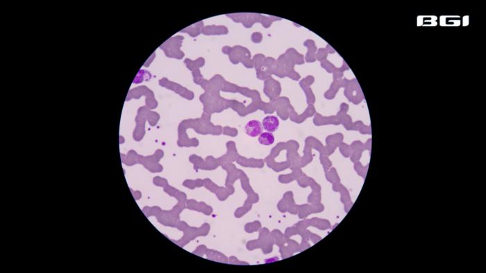 One Life Lost to Sepsis Every Three Seconds | BGI Insight
