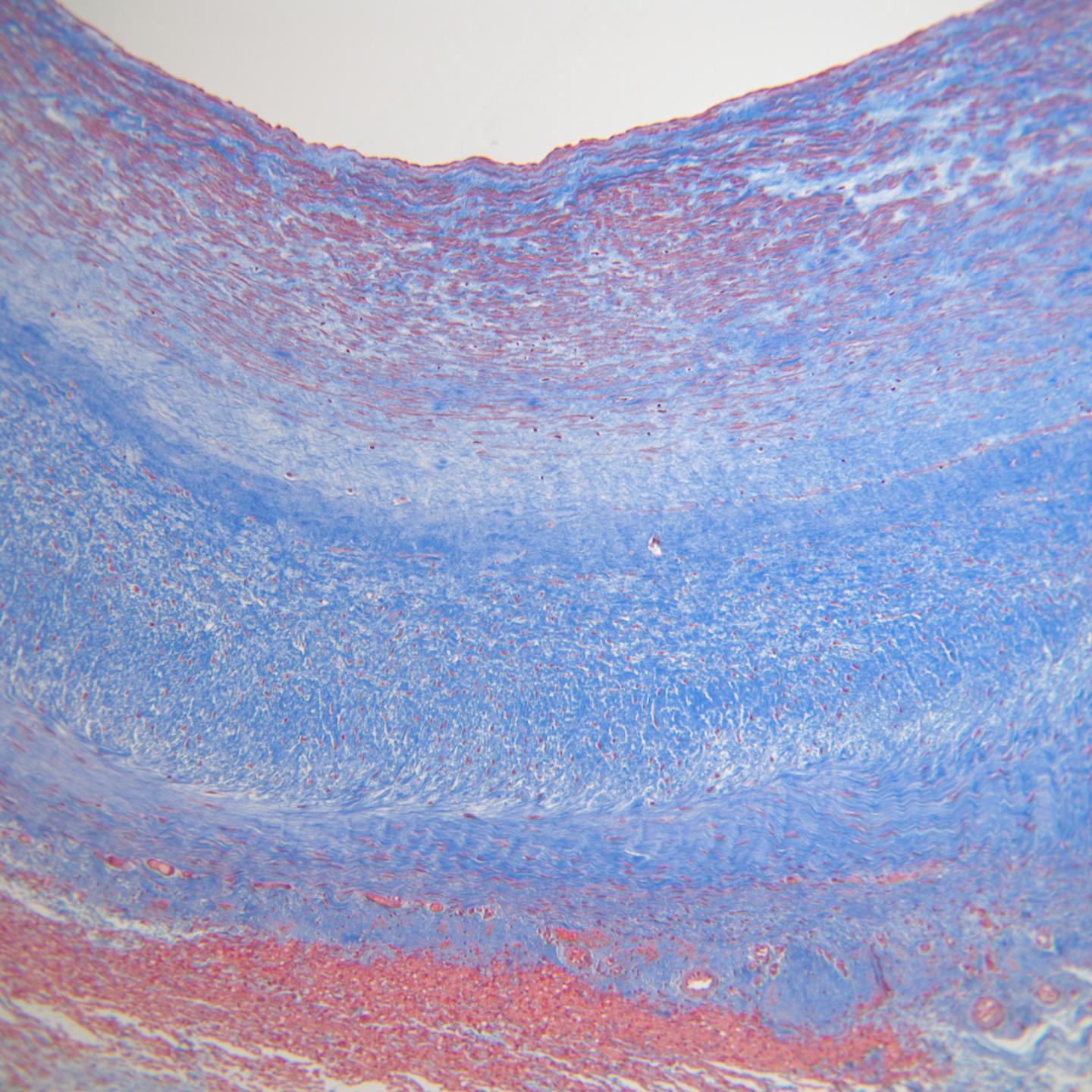Blood Vessel Grafts
