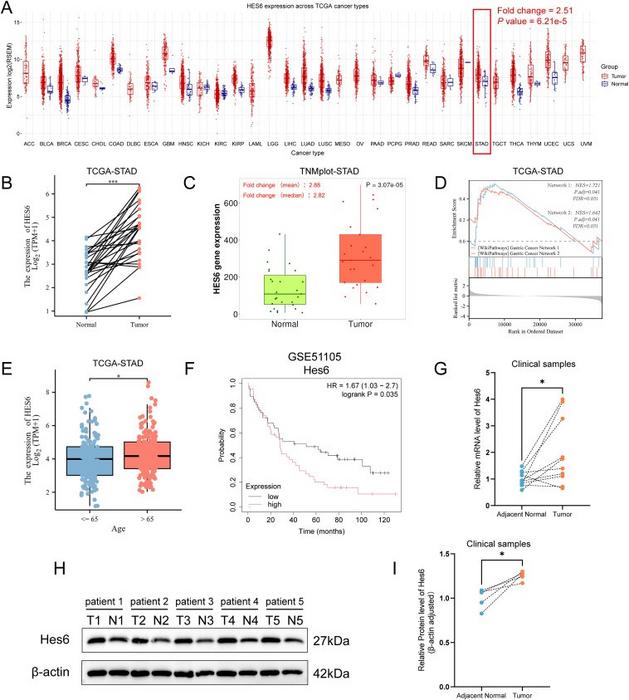 The expression of Hes6 is frequently up-regulated in tumor tissues of human gastric cancer (GC), and is associated with prognosis