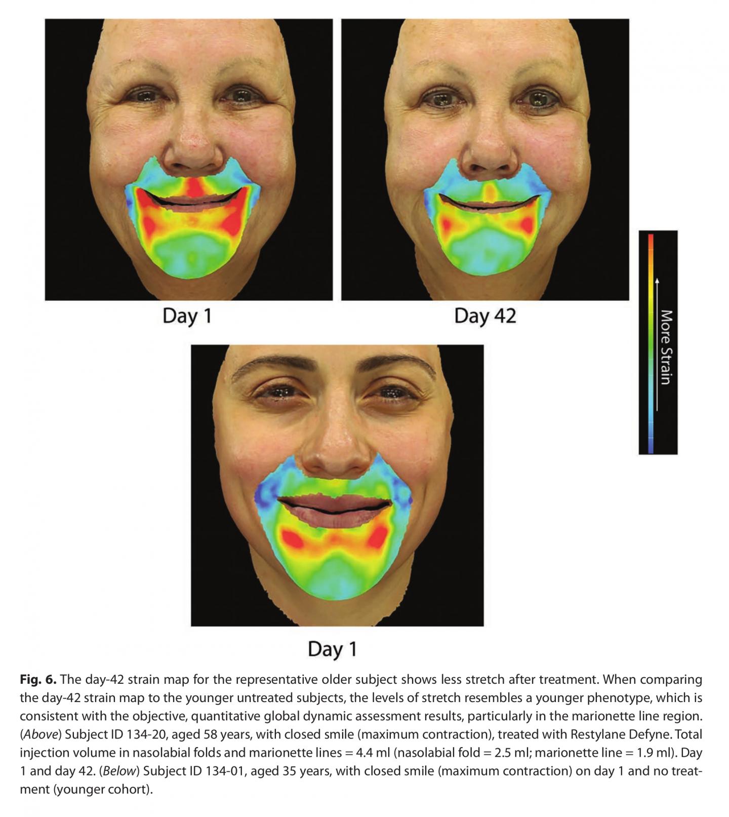 Hyaluronic Acid Fillers