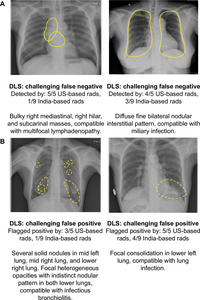 AI-based System Shows Promise in Tuberculosis Detection
