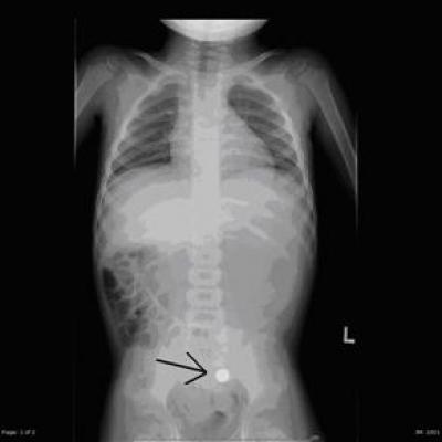 X-ray