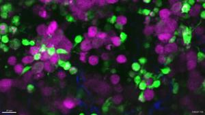 Macrophage engulfing melanoma - no overlay