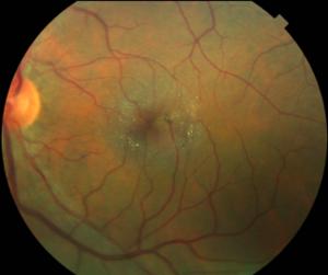 FDA approves ENCELTO, a first-of-its-kind eye implant that slows vision loss in rare eye disease