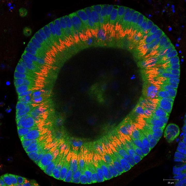 Cancer Organoid
