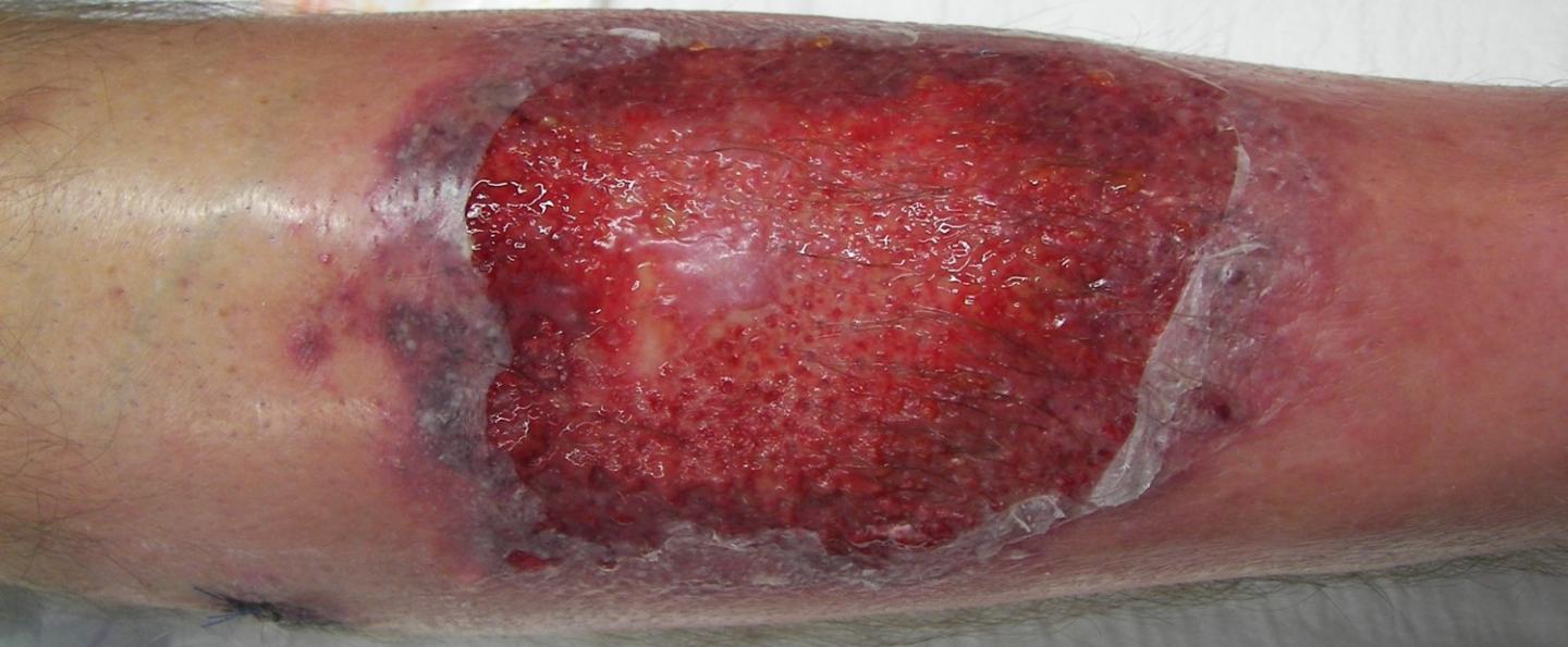 Pyoderma Lesion