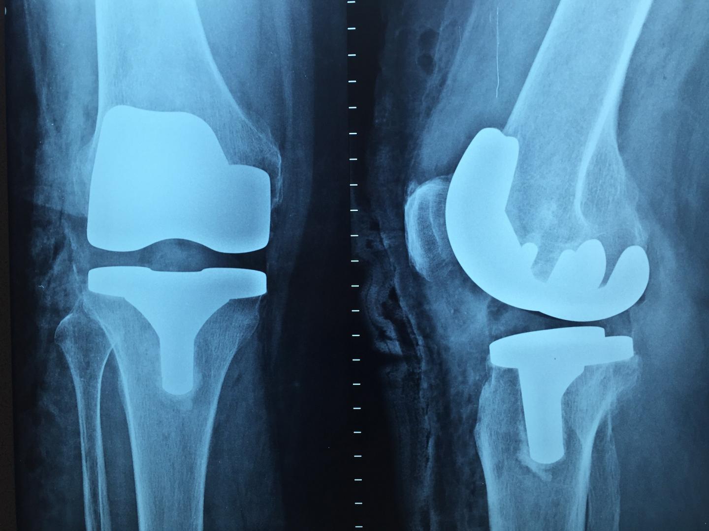 Replace, But Don't Rehospitalize