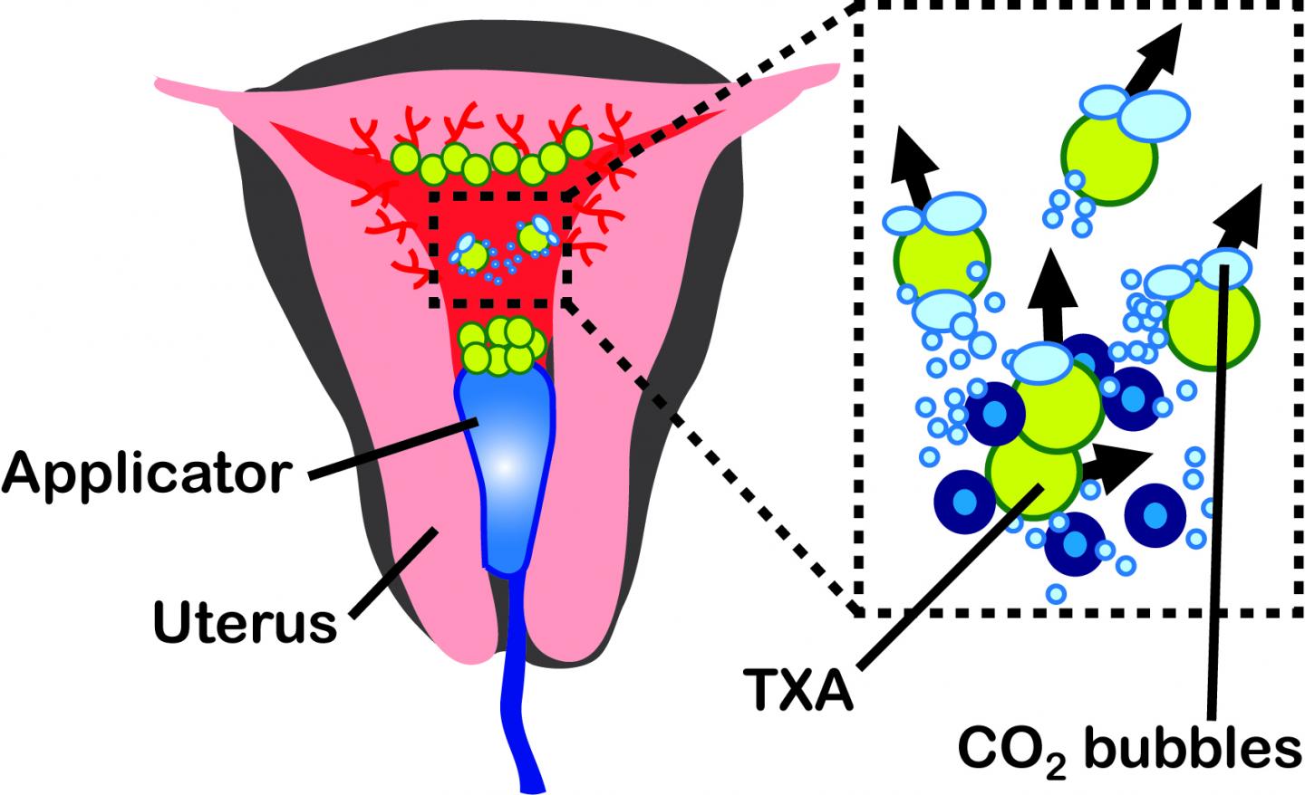 Gas-Propelled Microparticles Travel Deep into Wounds to Stop Bleeding (3 of 4)