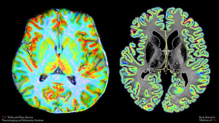 New brain imaging measure reveals how closely blood flow matches