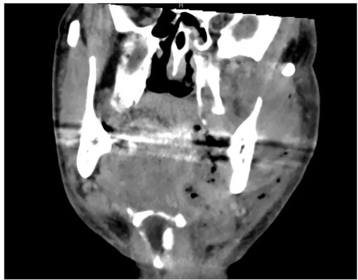 Necrotizing fasciitis of the head and neck – clinical features, diagnostics, and management strategies