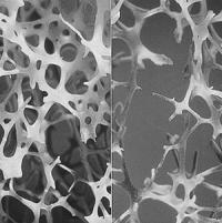 Osteoporosis (1 of 2)
