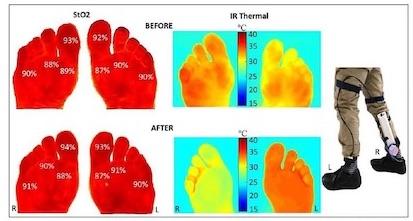Diabetic Foot Ulcers