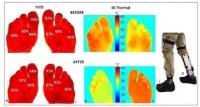 Diabetic Foot Ulcers
