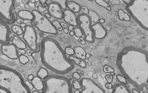 Remyelination EM picture.