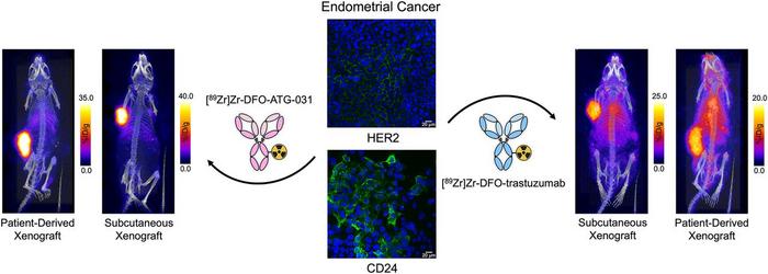 New Theranostic Targets Identified for Diagnosis and Treatment of Endometrial Cancer