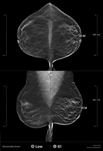Example of an interval cancer retrospectively detected by the AI algorithm
