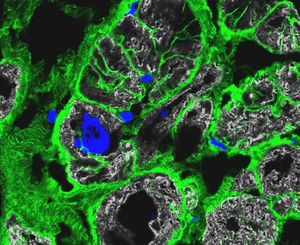 Immunofluorescence staining of diseased cardiac tissue