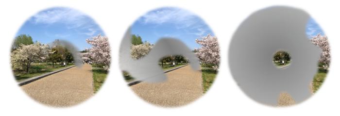 Visual field loss due to glaucoma