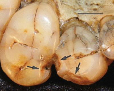 Tooth Chips
