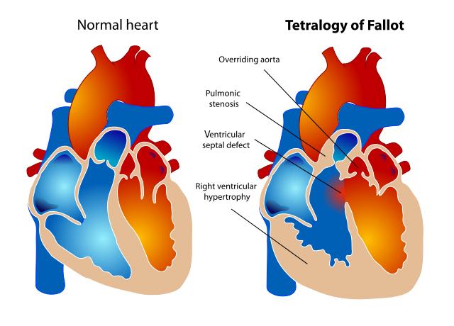 Tetralogy of Fallot Graphic