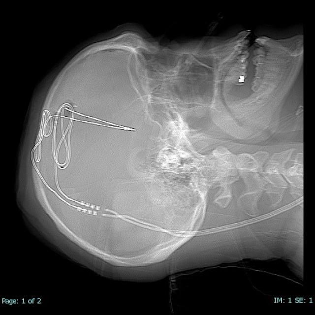 Implantation