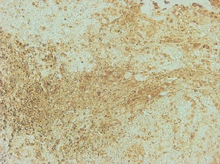 M2 Microglia in a Metastatic Brain Tumor
