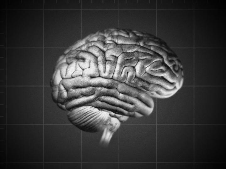 New Drug Helps Clear Amyloid Plaques in Alzheimer's Disease Patients