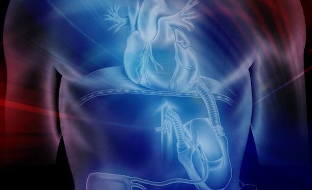 Artificial Heart