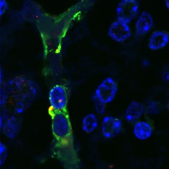 <i>E. coli</i> K1 meningitis