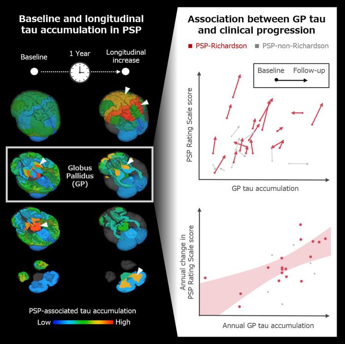 Tau accumulation in the globus pallidus is associated with clinical progression in progressive supranuclear palsy