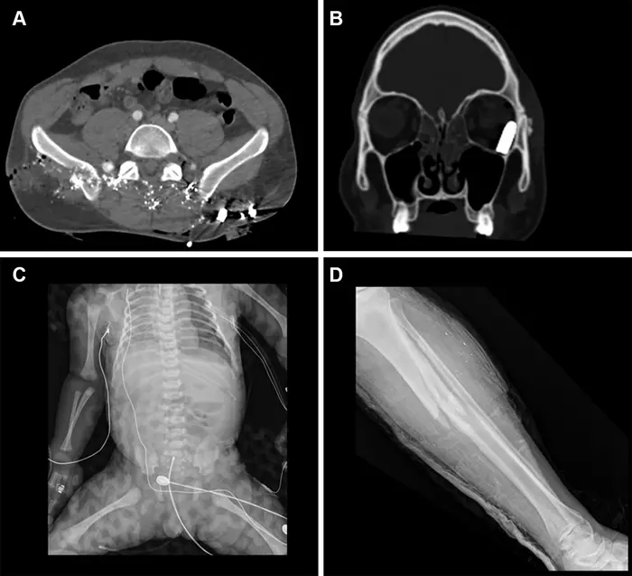 Representative injuries in patients from the mass casualty incident of October 7, 2023.