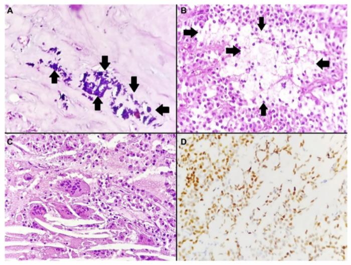 Massive calcified solid pseudopapillary neoplasm of the pancreatic head